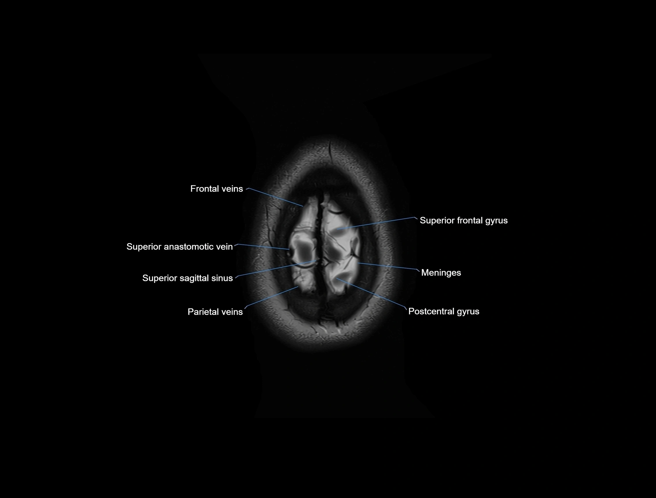 MRI Brain axial cross sectional radiology anatomy 3T image  -img-00001-00058.webp